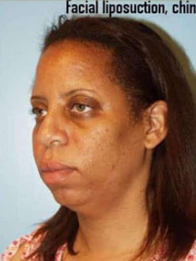Before Image: Facial Implant - left-front-oblique
