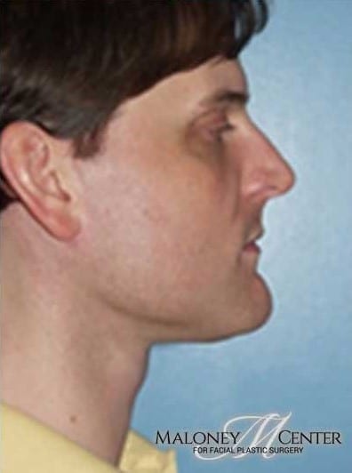 After Image: Facial Implant - right-side