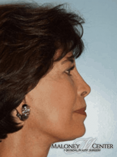 After Image: Facial Implant - right-side