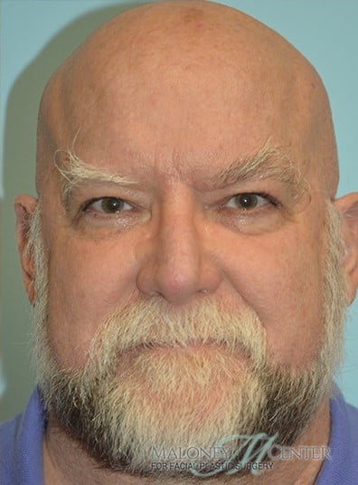 After Image: Facial Liposuction - front