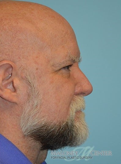 After Image: Facial Liposuction - right-side