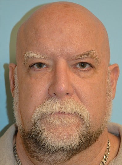 Before Image: Facial Liposuction - front