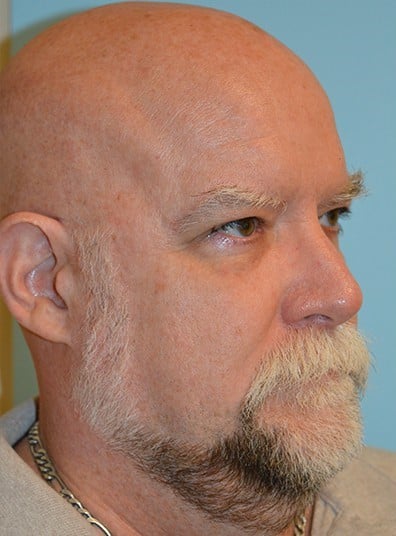 Before Image: Facial Liposuction - right-front-oblique