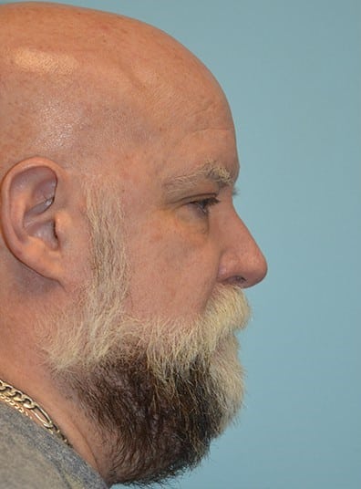 Before Image: Facial Liposuction - right-side