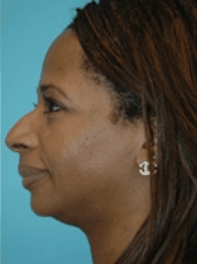Before Image: Facial Liposuction - left-side