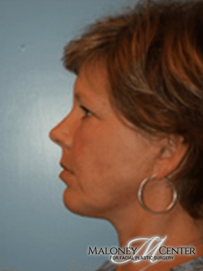 After Image: Facial Liposuction - left-side
