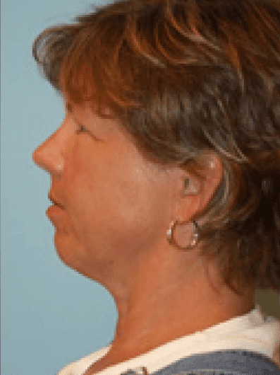 Before Image: Facial Liposuction - left-side
