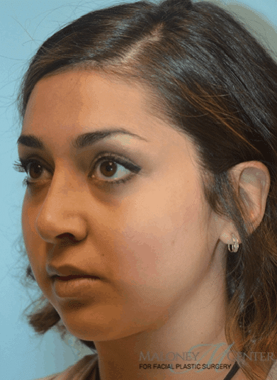 After Image: Facial Liposuction - left-front-oblique