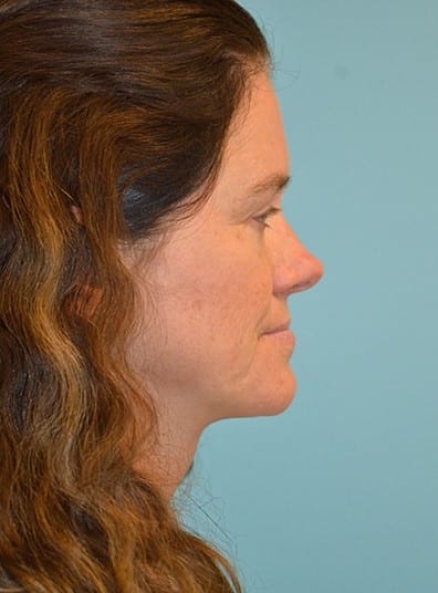 After Image: Facial Liposuction - right-side