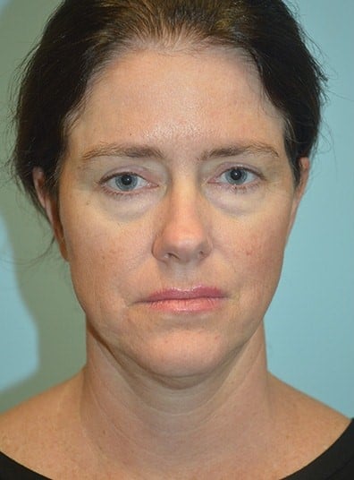 Before Image: Facial Liposuction - front