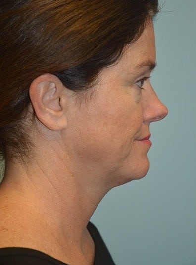 Before Image: Facial Liposuction - right-side