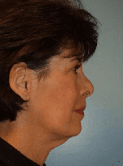 Before Image: Facial Liposuction - right-side
