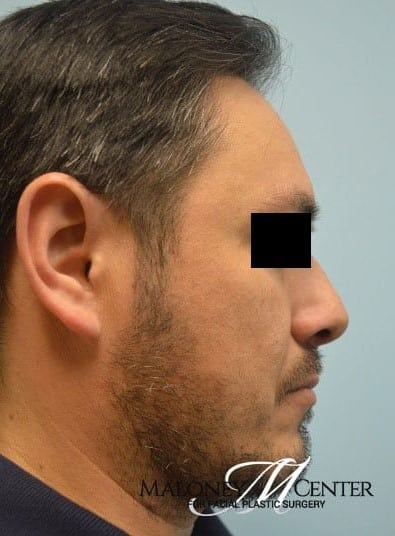 After Image: Facial Liposuction - right-side
