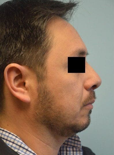 Before Image: Facial Liposuction - right-side