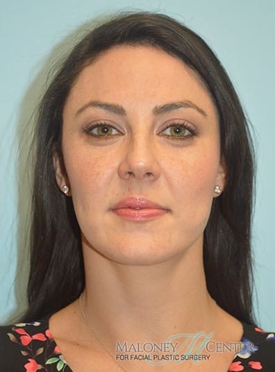 After Image: Facial Liposuction - front