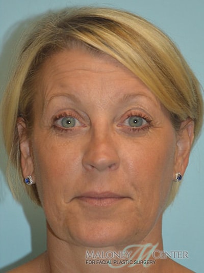 After Image: Facial Liposuction - front