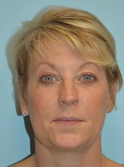 Before Image: Facial Liposuction - front