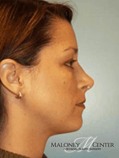 After Image: Facial Liposuction - right-side