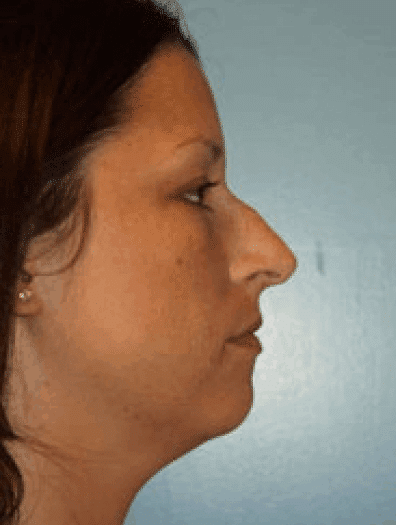 Before Image: Facial Liposuction - right-side