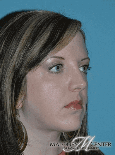 After Image: Facial Liposuction - right-front-oblique