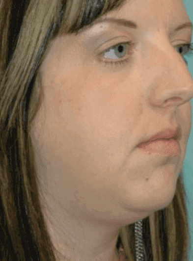 Before Image: Facial Liposuction - right-front-oblique