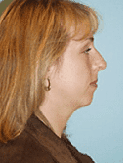 Before Image: Facial Liposuction - right-side