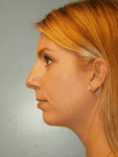 Before Image: Facial Liposuction - left-side