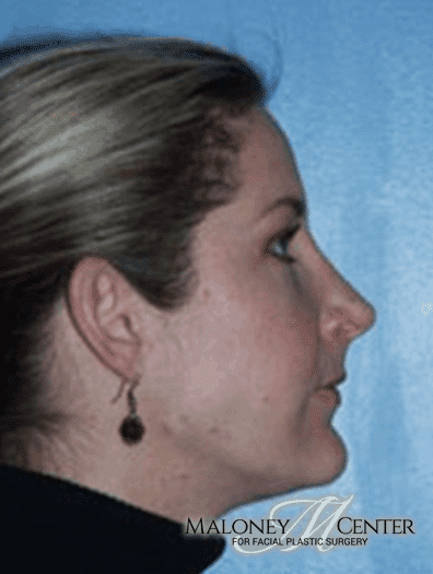 After Image: Facial Liposuction - left-side