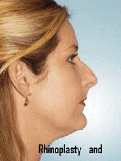 Before Image: Facial Liposuction - left-side
