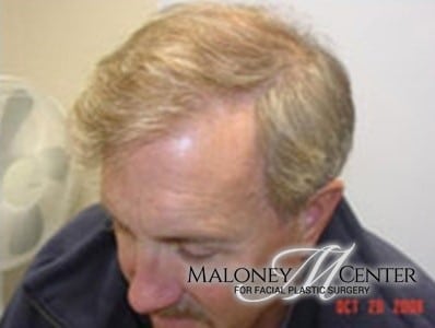After Image: Hair Restoration - front