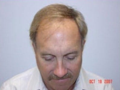 Before Image: Hair Restoration - front