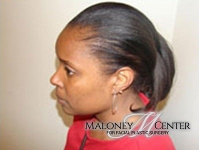 After Image: Hair Restoration - left-front-oblique