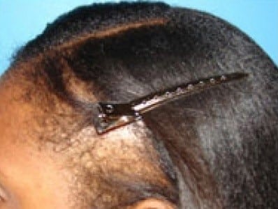 Before Image: Hair Restoration - left-front-oblique