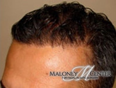 After Image: Hair Restoration - left-front-oblique