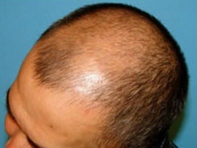 Before Image: Hair Restoration - left-front-oblique