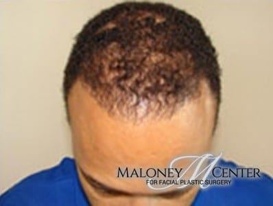 After Image: Hair Restoration - front