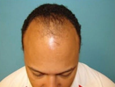 Before Image: Hair Restoration - front