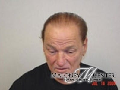 After Image: Hair Restoration - front