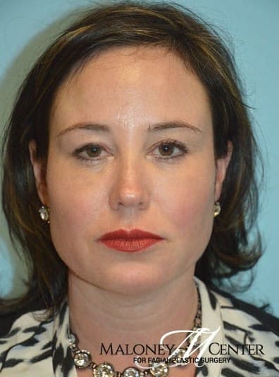 After Image: Juvederm - front