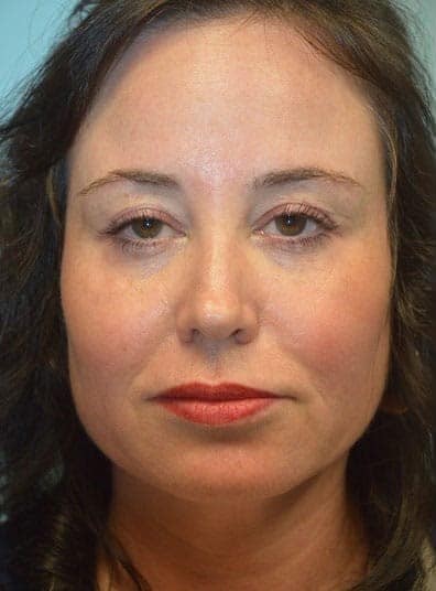 Before Image: Juvederm - front