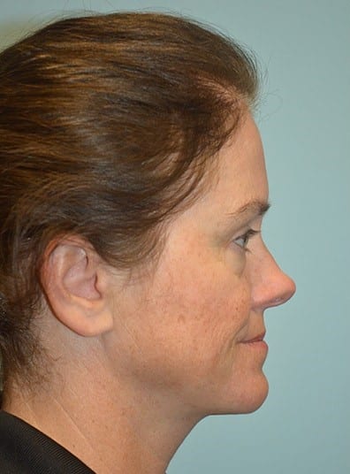 Before Image: Juvederm - right-side