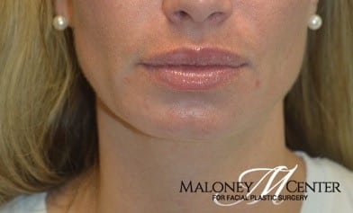 After Image: Juvederm - front