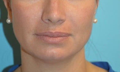 Before Image: Juvederm - front