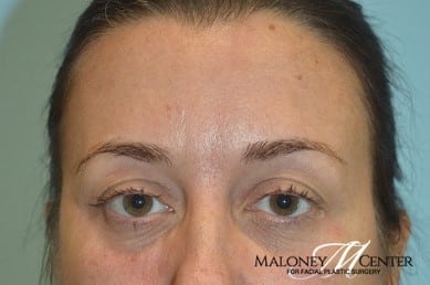 After Image: Juvederm - front