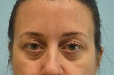 Before Image: Juvederm - front
