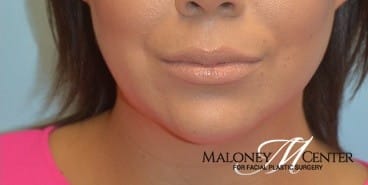 After Image: Juvederm - front