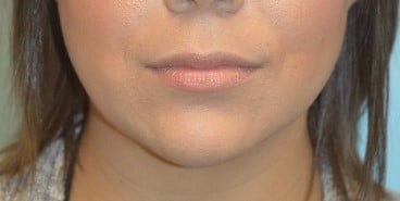 Before Image: Juvederm - front