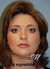 After Image: Lip Enhancement Gallery - front