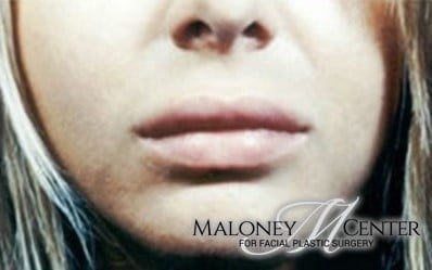 After Image: Lip Enhancement Gallery - front