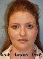 Before Image: Lip Enhancement Gallery - front